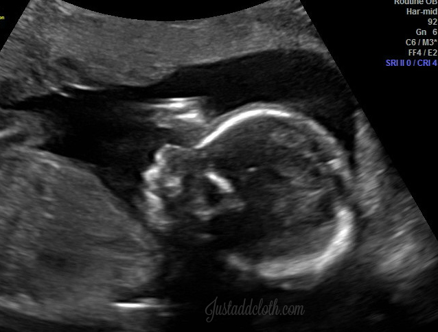21 weeks ultrasound girl